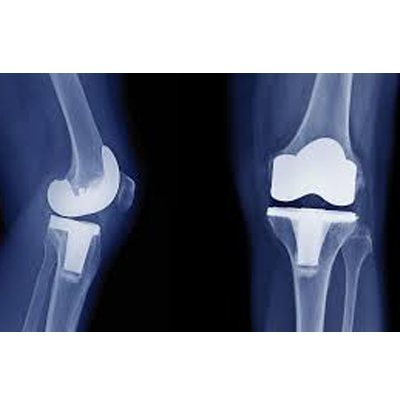 Knee Pain Treatment in Singapore