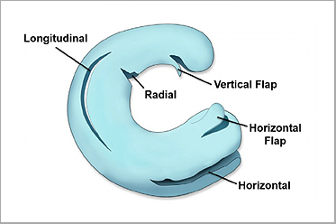Vertical/Longitudinal Tear