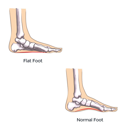 What are flat feet?