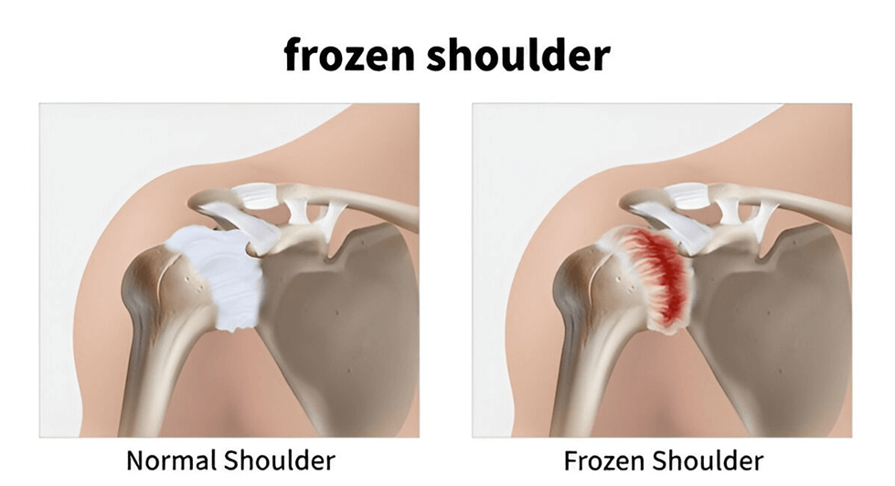 image (16) What Is Frozen Shoulder (Adhesive Capsulitis)?