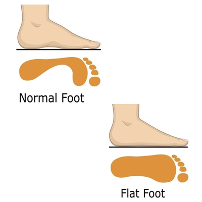What is the treatment option for flat feet?